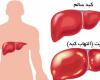 آسیب کبدی,علائم آسیب کبد,زردی,تهوع,shabnamha.ir,شبنم همدان,afkl ih,شبنم ها