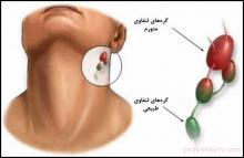 تورم غدد لنفاوی غدد لنفاوی,تورم غدد لنفاوی,درمان متورم شدن غدد لنفاوی,غده لنفی,گره های لنفاوی,shabnamha.ir,شبنم همدان,afkl ih,شبنم ها